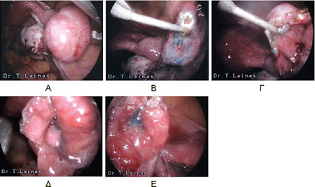 Salpingostomy